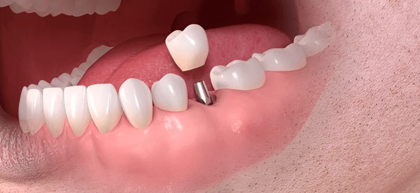 All-on-6 Dental Implants in Turkey related image