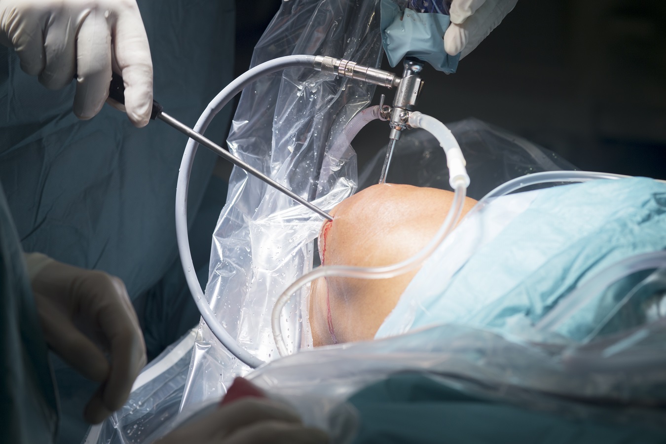 Best Countries for Arthroscopic Knee Surgery Abroad related image