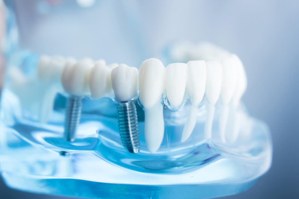 All-on-6 Dental Implants Poland related image