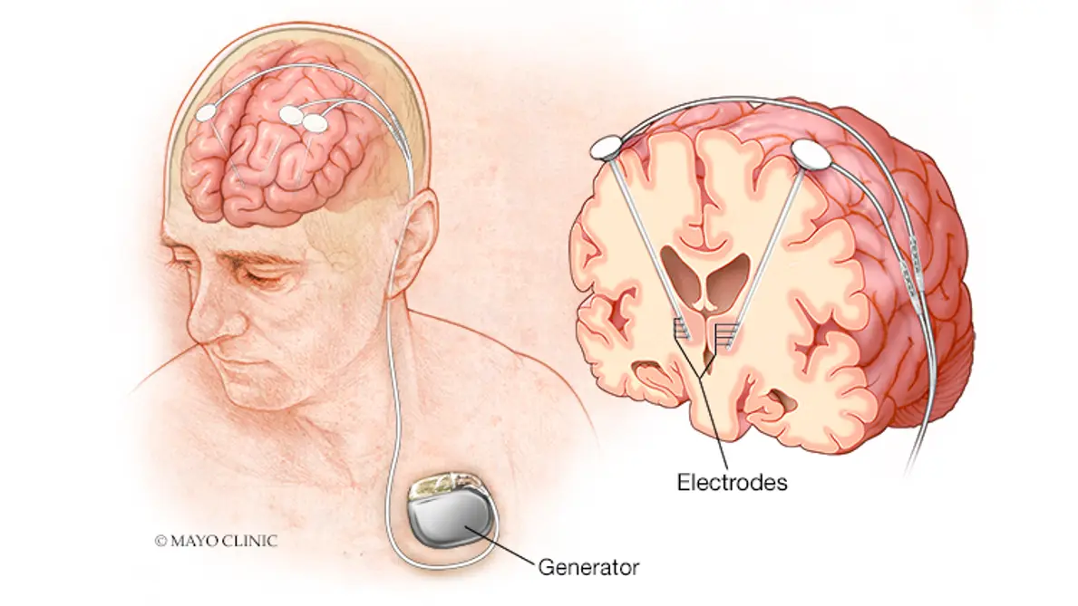 Parkinson's Treatment in Turkey - Best Clinics, Costs, Doctors related image