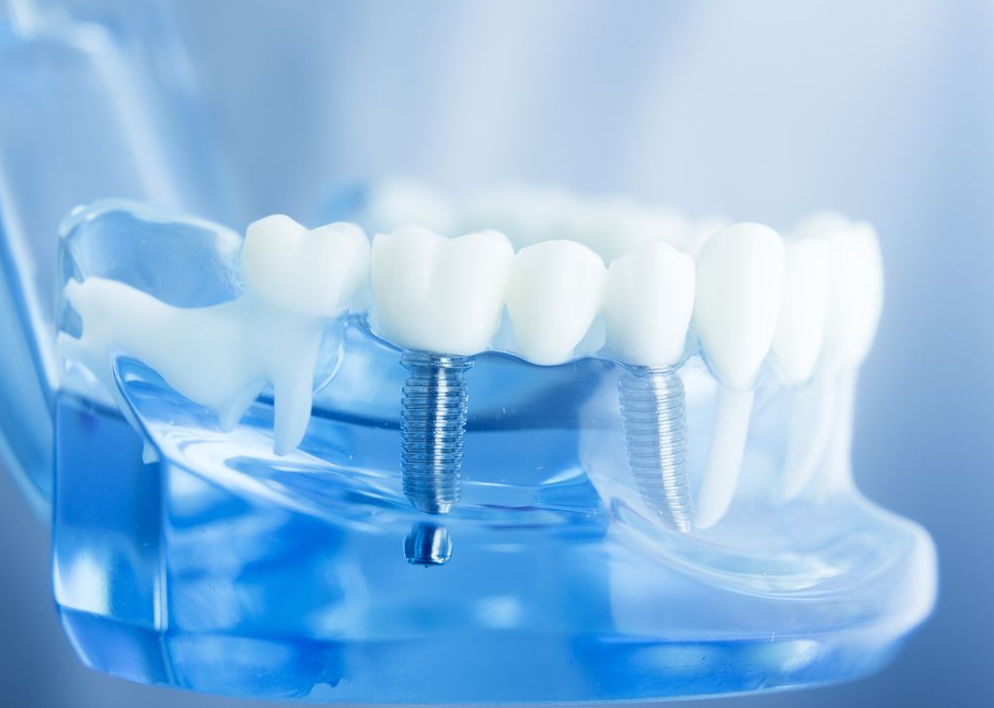 All-on-6 Dental Implants Poland related image