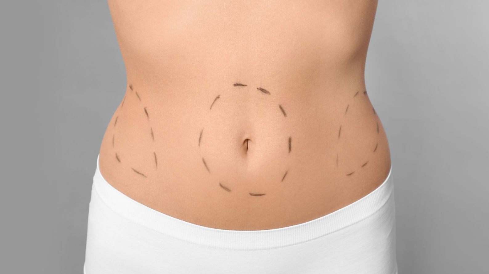 Liposuction in Turkey - Best Clinics, Costs and Packages related image