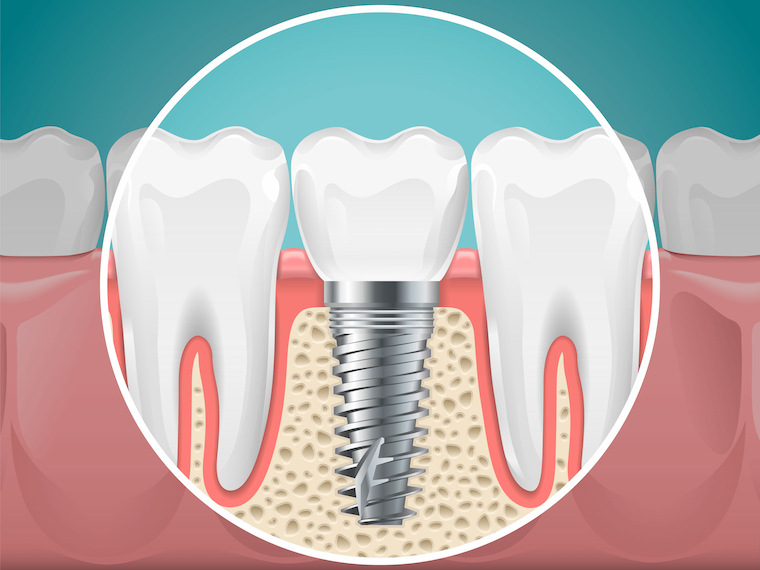 Full Mouth Dental Implants Turkey Package Deals related image