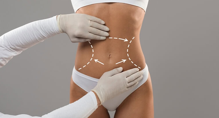 Liposuction in Turkey - Best Clinics, Costs and Packages related image