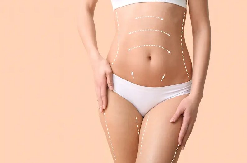 Liposuction in Turkey - Best Clinics, Costs and Packages related image