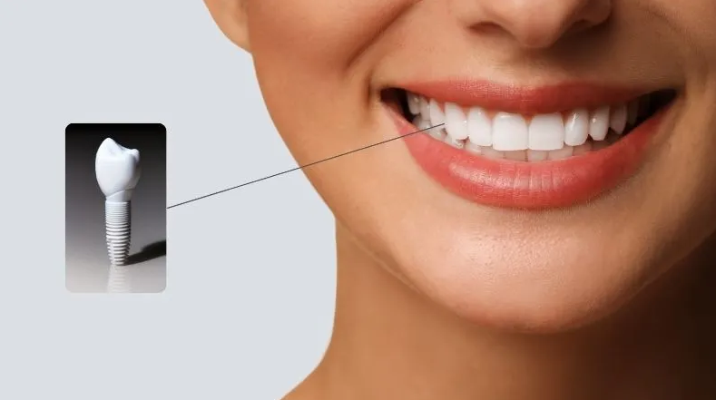 All-on-6 Dental Implants in Turkey related image