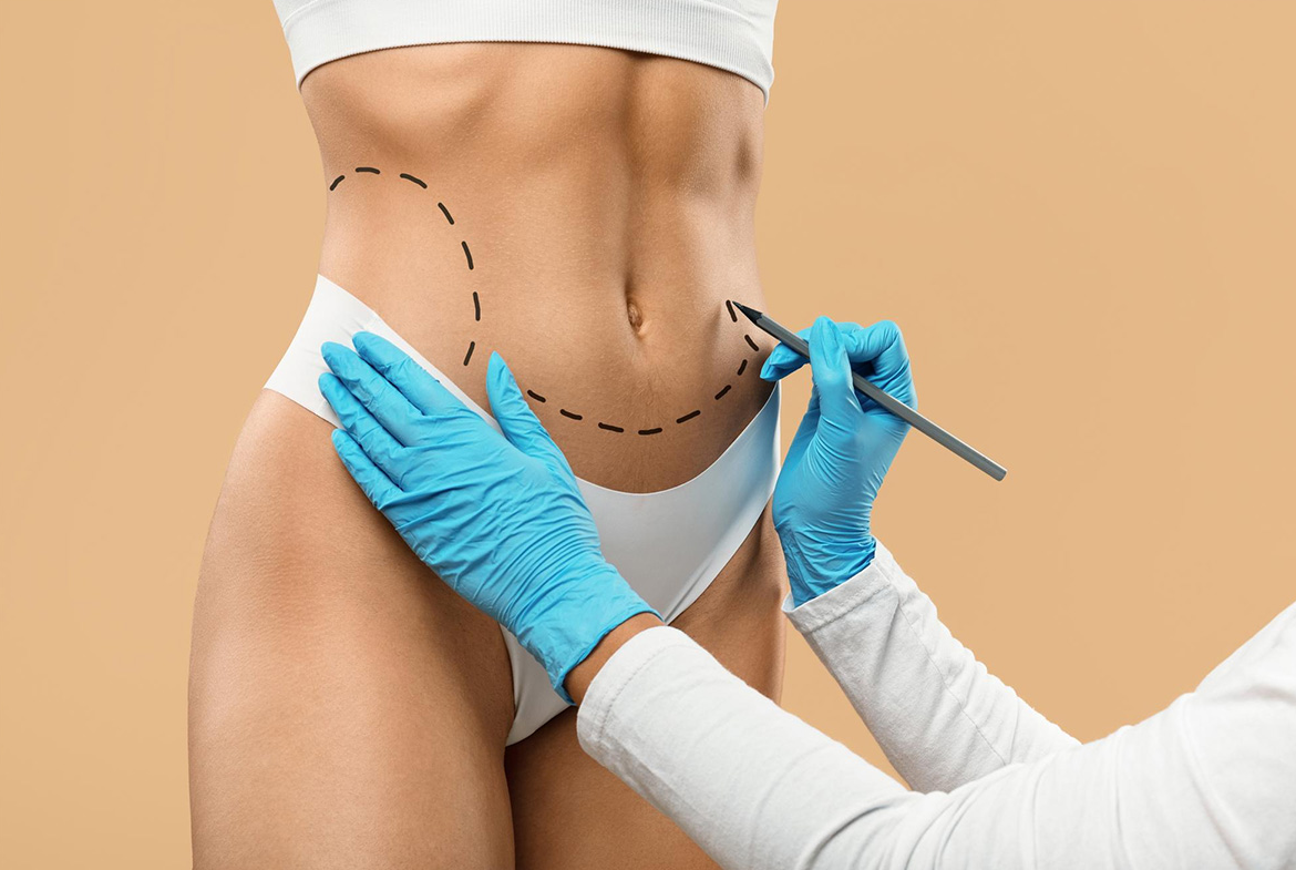 Liposuction in Turkey - Best Clinics, Costs and Packages related image