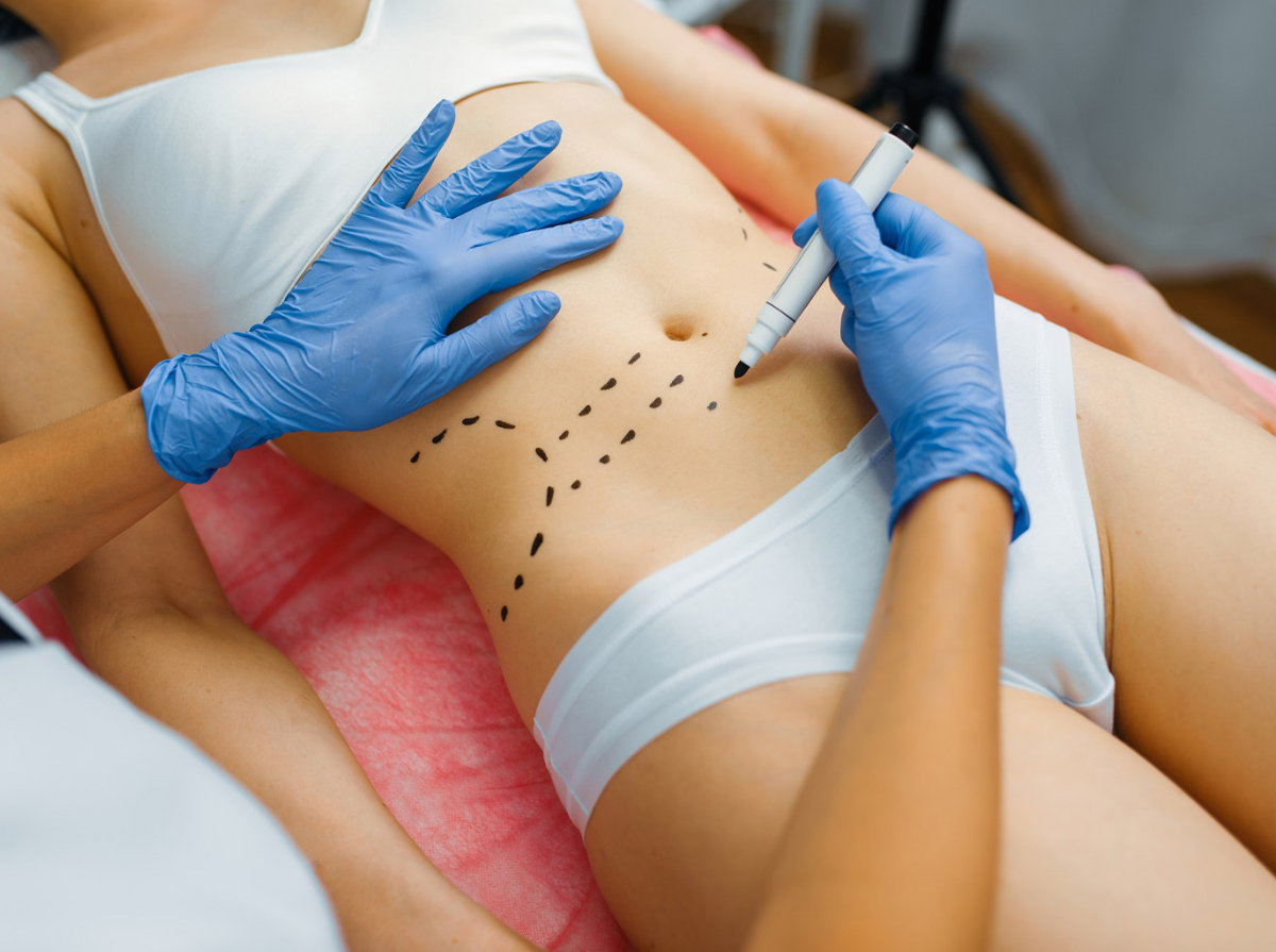 Liposuction in Turkey - Best Clinics, Costs and Packages related image