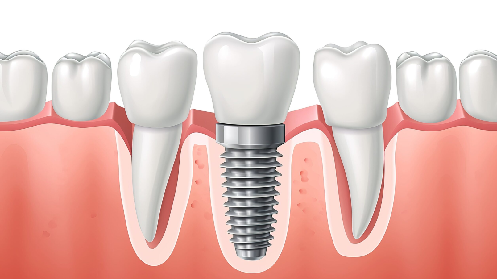 All-on-6 Dental Implants in Turkey related image
