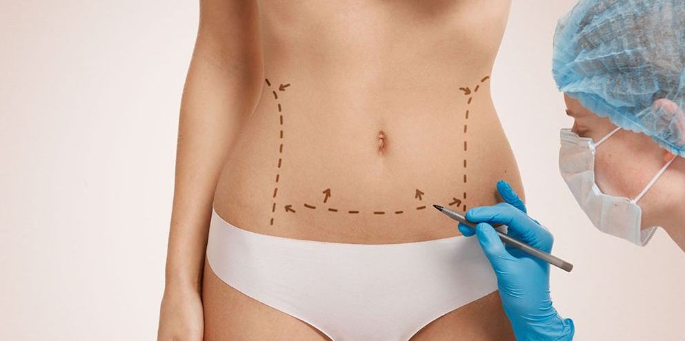 Liposuction in Turkey - Best Clinics, Costs and Packages related image