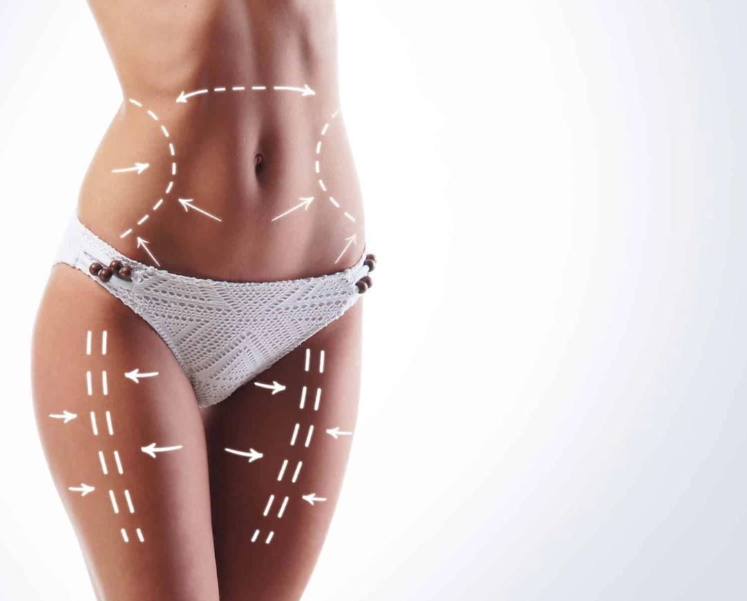 Liposuction in Turkey - Best Clinics, Costs and Packages related image