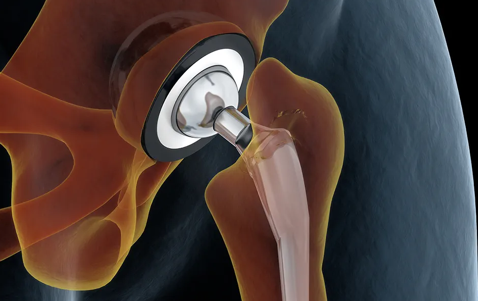 Hip Replacement Surgery in Switzerland: Costs, Hospitals and Recovery related image