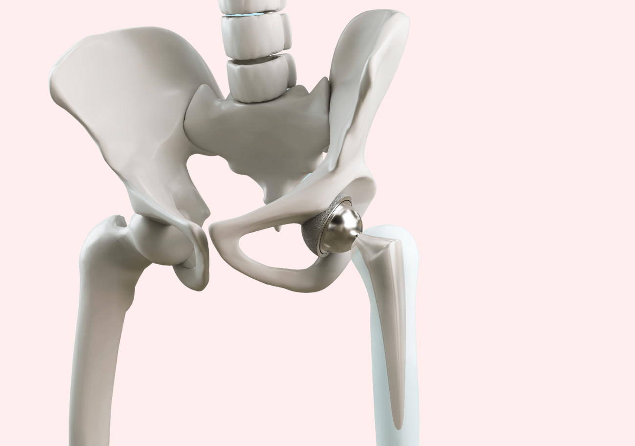Hip Replacement Surgery in Switzerland: Costs, Hospitals and Recovery related image
