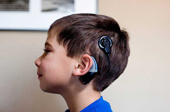 Best and Cheapest Countries for Cochlear Implant Abroad related image
