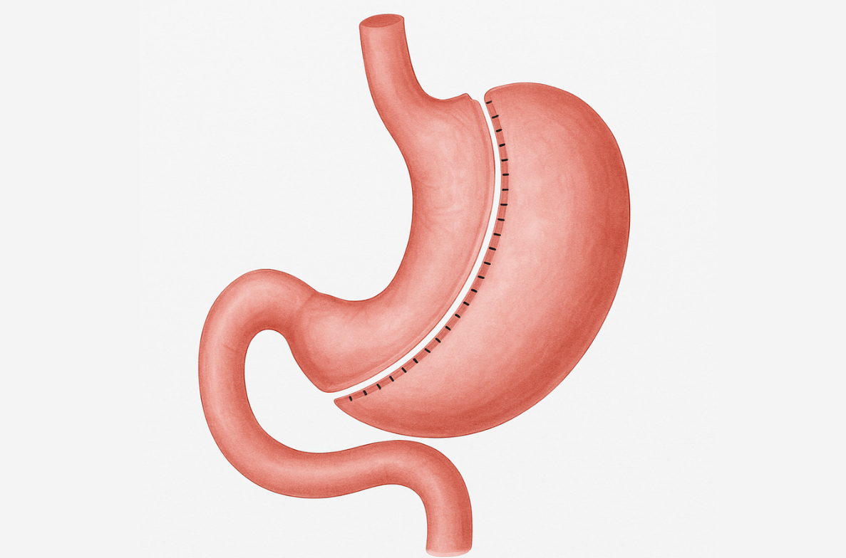 Revision Bariatric Surgery Turkey | 2026 Costs & Clinics related image