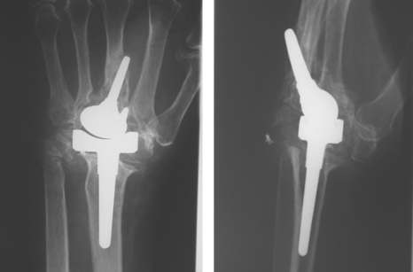 Wrist Replacement Surgery in Turkey related image