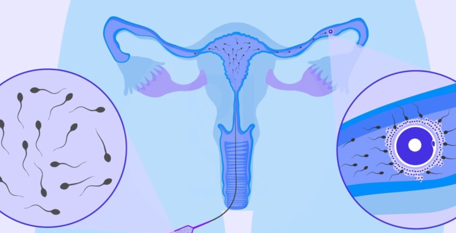 IUI Treatment in Turkey related image