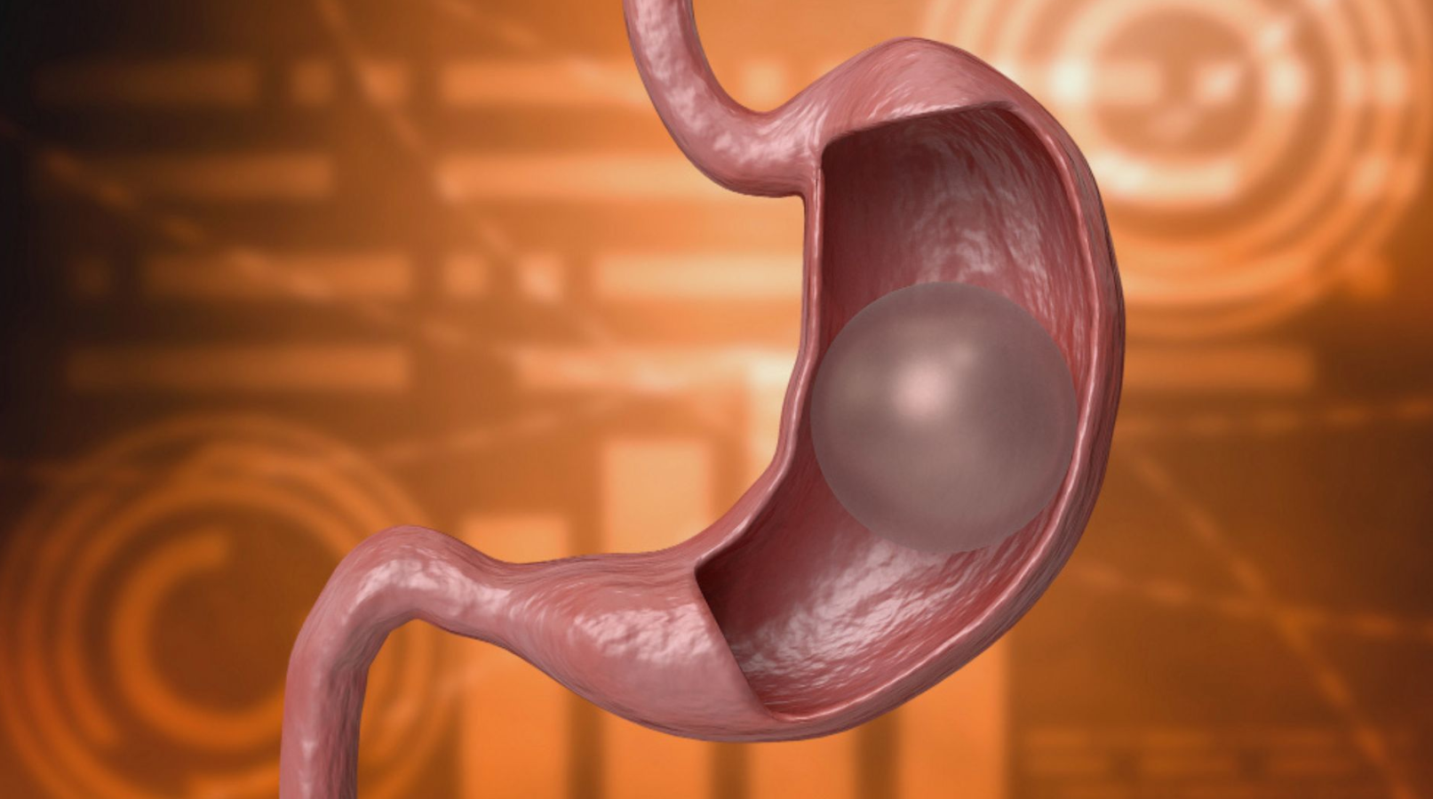 Gastric Balloon In Turkey: Guaranteed Results & 2026 Costs related image