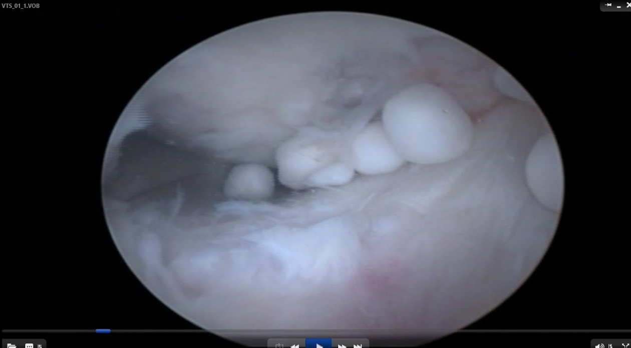 Arthroscopic Knee Surgery in Turkey - Costs and Best Clinics related image