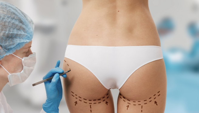 BBL in Turkey (Brazilian Butt Lift) related image