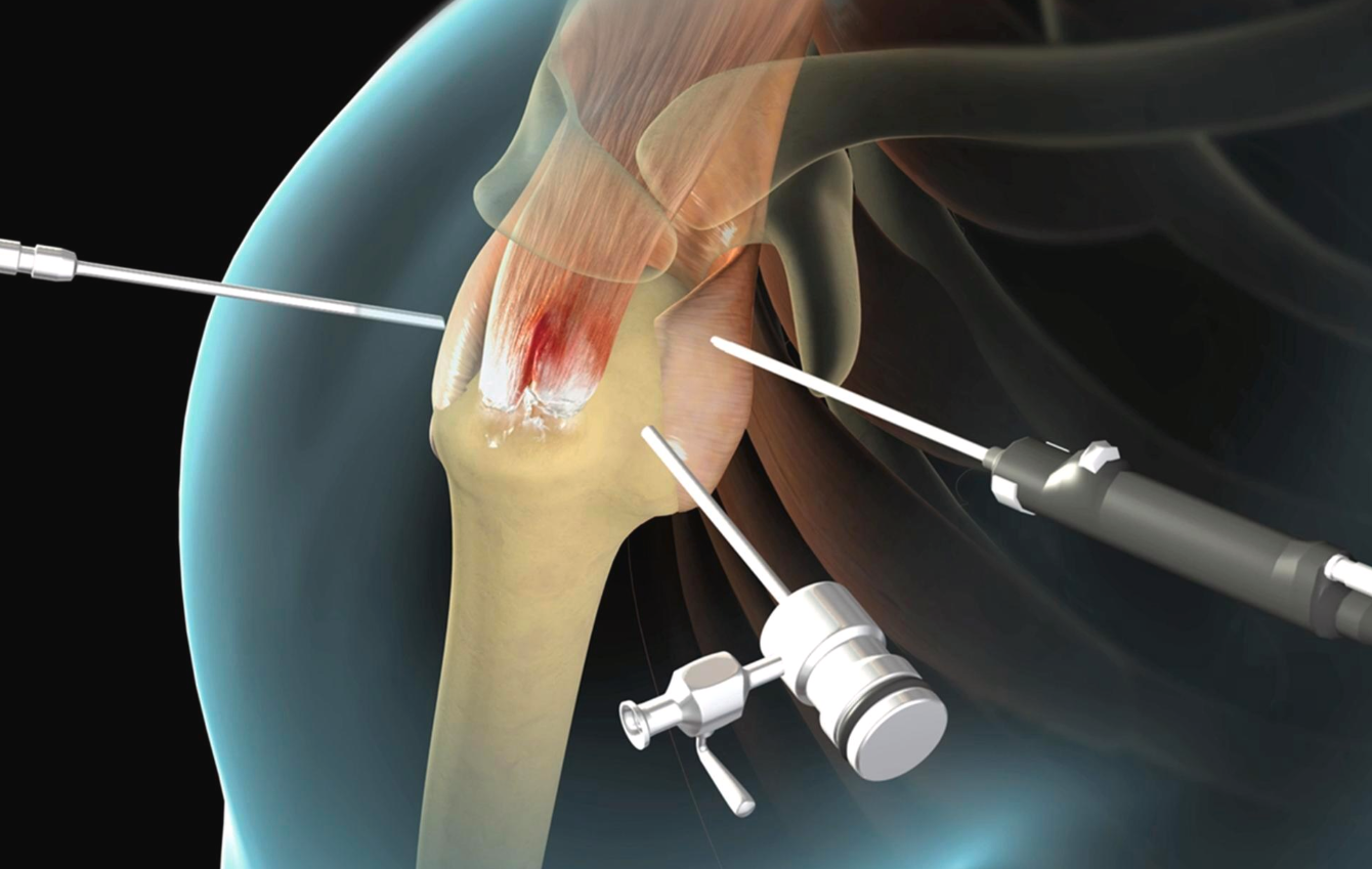 Best and Cheapest Countries for Rotator Cuff Repair Abroad related image