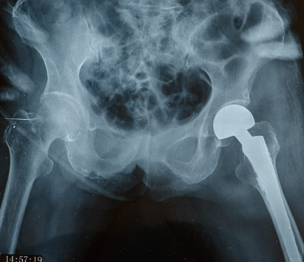 Hip Replacement Surgery in Turkey: Cost, Best Hospitals & Recovery [2026] related image