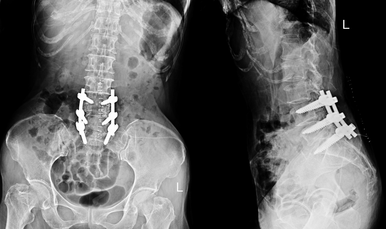 Spinal Fusion Surgery in Switzerland related image