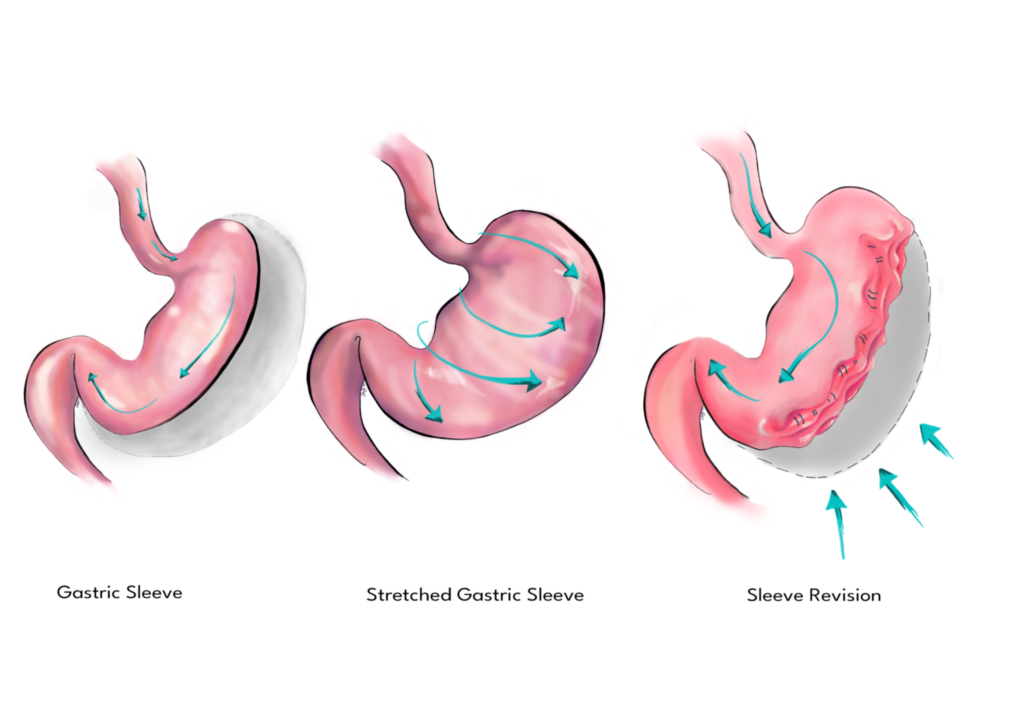 Revision Bariatric Surgery Turkey | 2026 Costs & Clinics related image