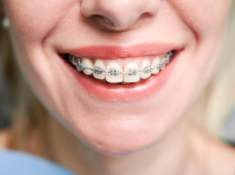 Dental Treatment in Turkey related image