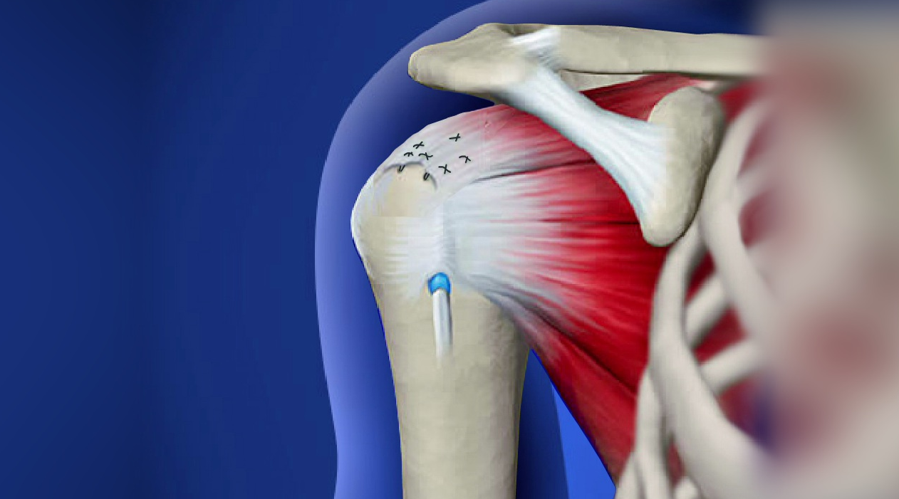 Rotator Cuff Repair in Turkey - Costs, Clinics and Guide related image