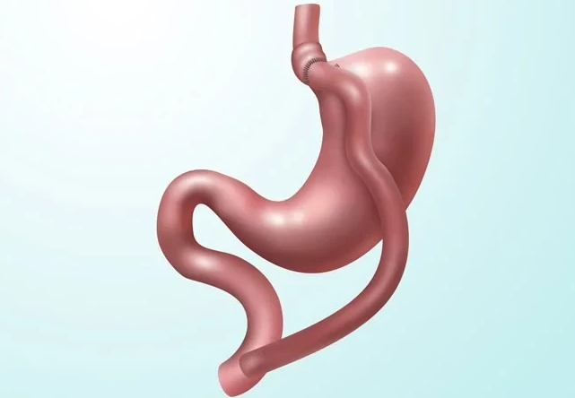 Gastric Bypass Surgery In Turkey: 2026 Prices & Packages related image