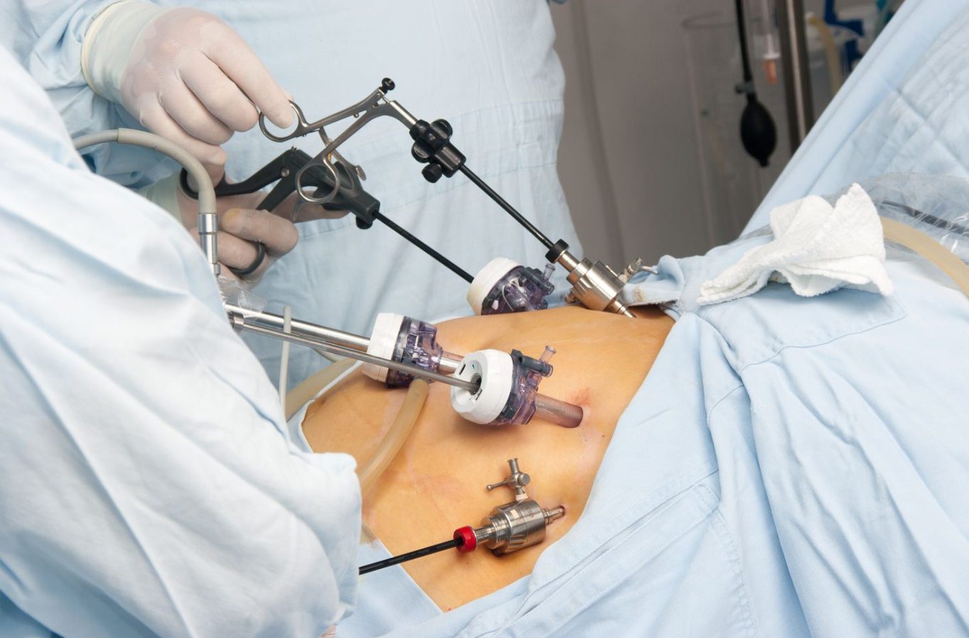 Gastric Bypass Surgery In Turkey: 2026 Prices & Packages related image