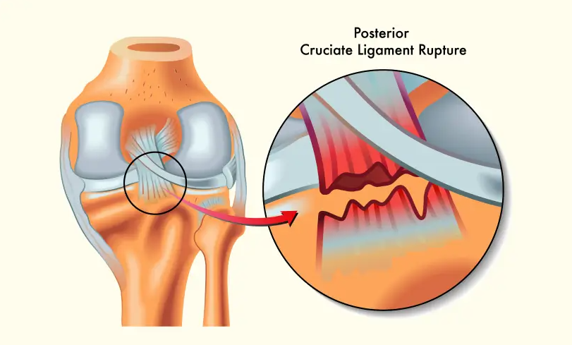 Arthroscopic Knee Surgery in Turkey - Costs and Best Clinics related image