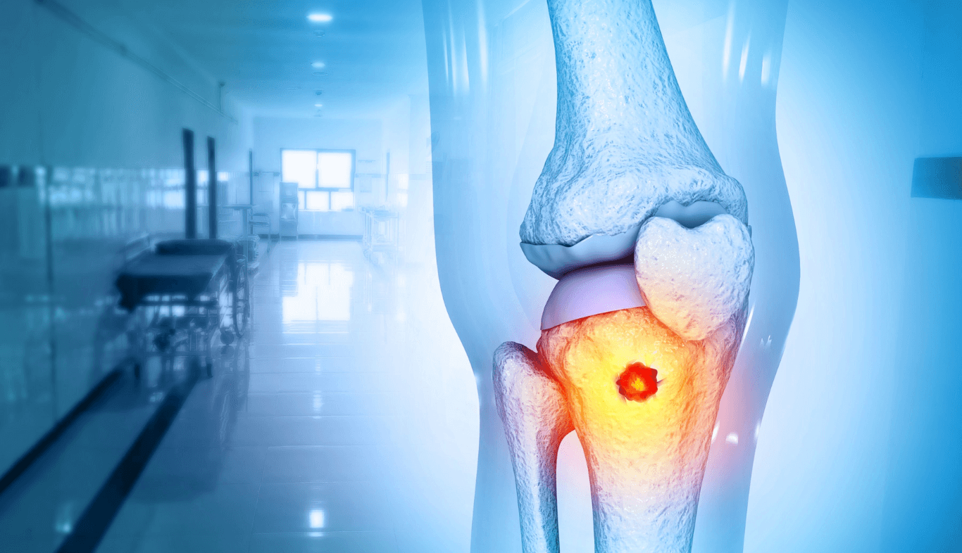 Bone Cancer Treatment in Turkey related image