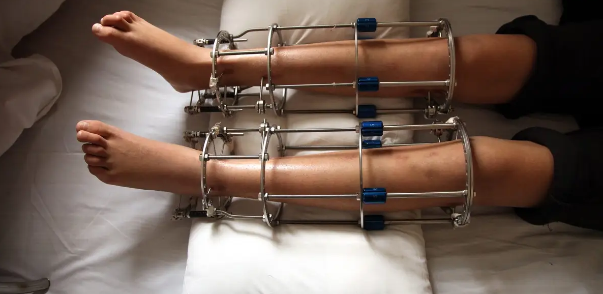Limb Lengthening Surgery in Turkey: 2026 Costs and Best Clinics related image