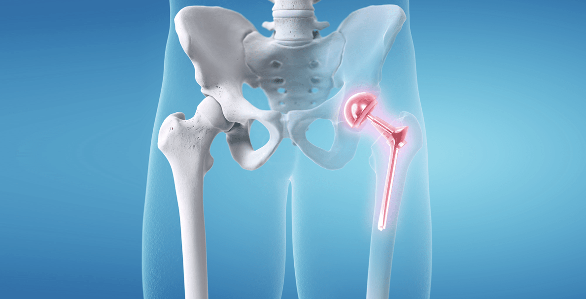 Hip Replacement Surgery in Turkey: Cost, Best Hospitals & Recovery [2026] related image