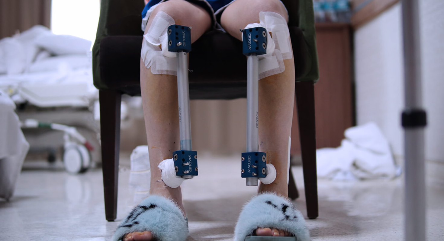 Best and Cheapest Countries for Limb Lengthening Surgery Abroad related image