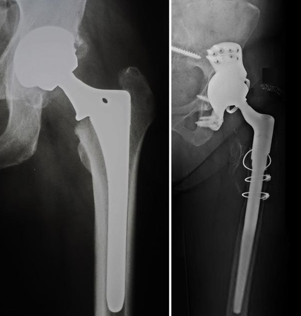 Hip Replacement Surgery in Turkey: Cost, Best Hospitals & Recovery [2026] related image