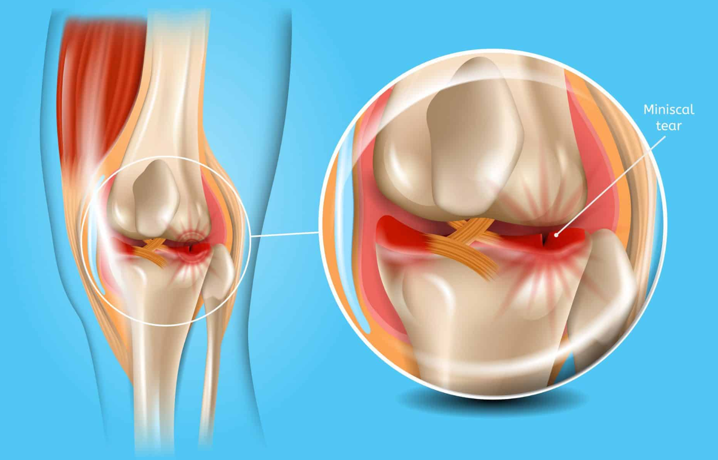 Arthroscopic Knee Surgery in Turkey - Costs and Best Clinics related image