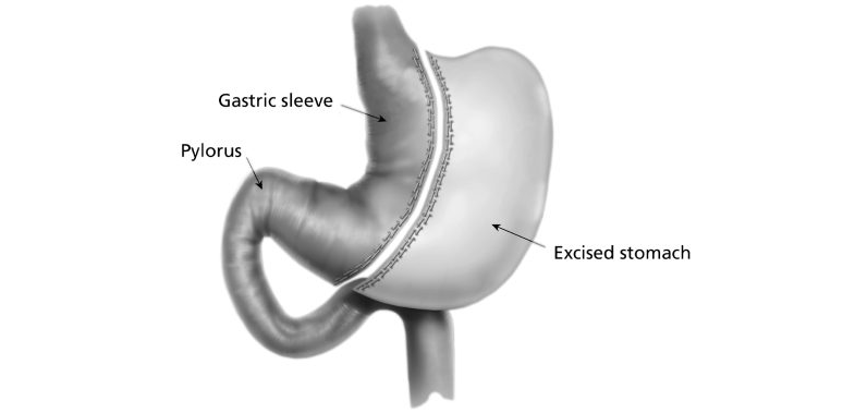 Gastric Sleeve in Turkey | 2026 Prices, & Top Hospitals related image