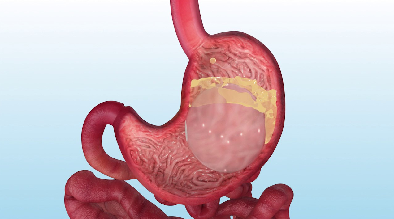 Gastric Balloon In Turkey: Guaranteed Results & 2026 Costs related image