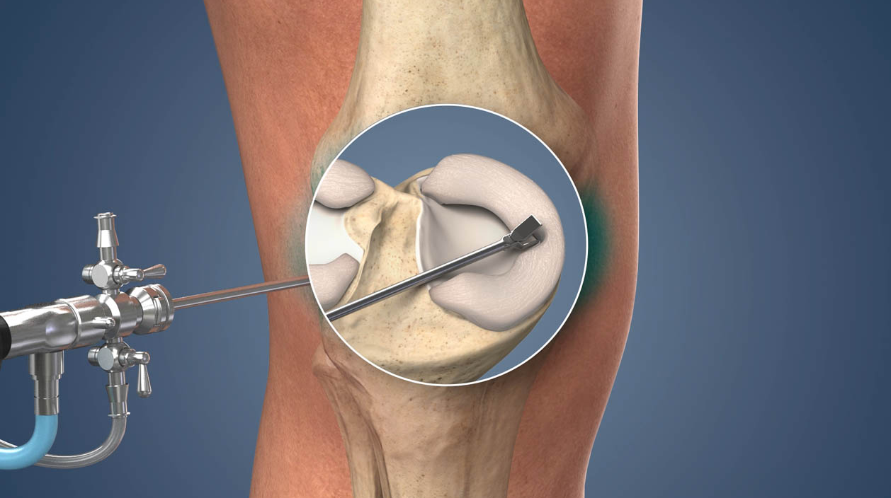 Arthroscopic Knee Surgery in Turkey - Costs and Best Clinics related image
