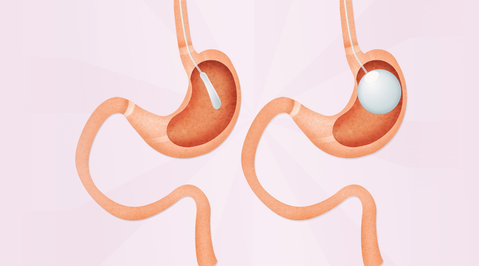 Gastric Balloon In Turkey: Guaranteed Results & 2026 Costs related image
