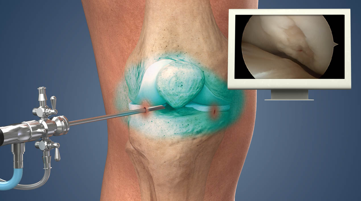Arthroscopic Knee Surgery in Turkey - Costs and Best Clinics related image
