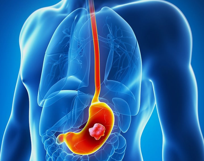 Stomach Cancer Treatment in Turkey related image
