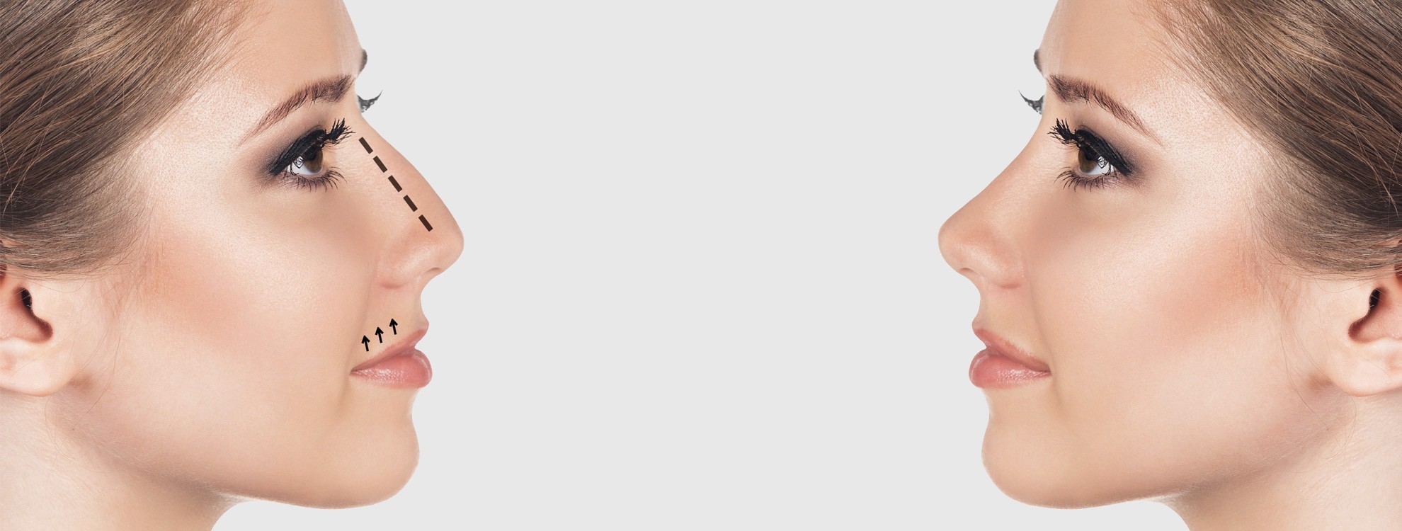 Nose Job Turkey - Affordable Rhinoplasty Packages from 2000€ related image