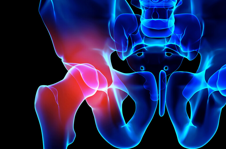 Hip Arthroscopy in Turkey related image
