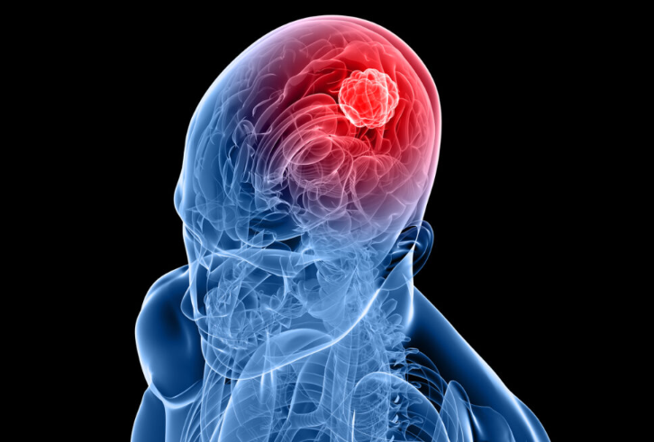 Brain Tumour Treatment in Turkey | 2026 Costs, Clinics related image