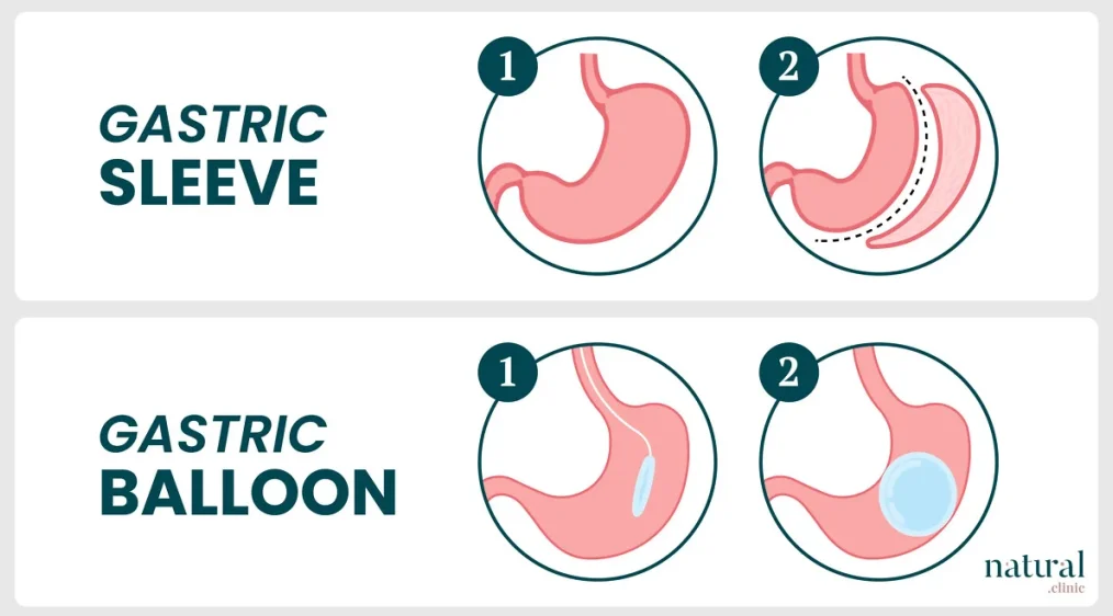 Gastric Balloon In Turkey: Guaranteed Results & 2026 Costs related image
