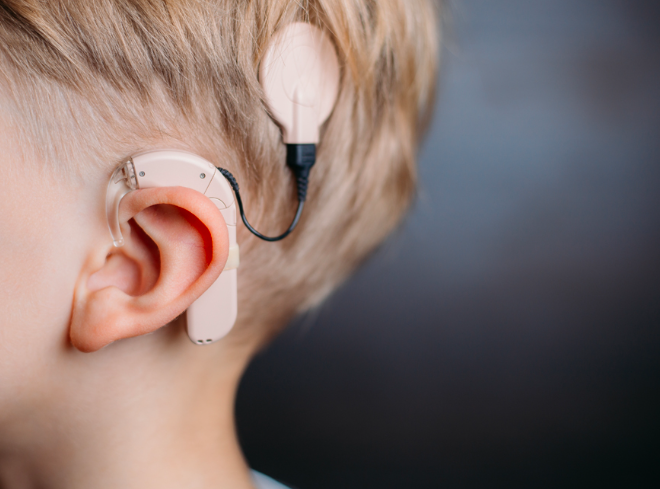 Best and Cheapest Countries for Cochlear Implant Abroad related image